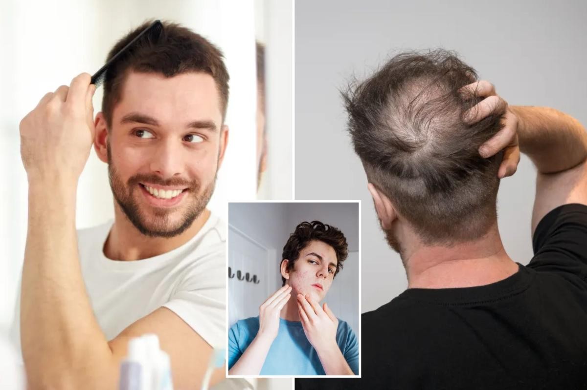 دواء موضعي لعلاج حب الشباب يُظهر نتائج واعدة في علاج الصلع الوراثي