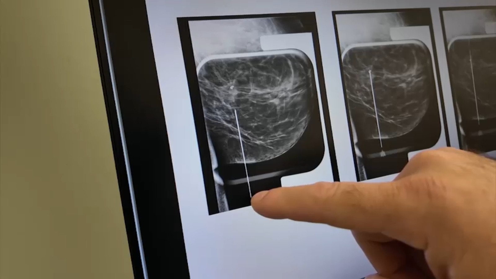 مستشفى ستوني بروك في لونغ آيلاند يواصل تجنيد مرضى لتجربة لقاح ضد سرطان الثدي