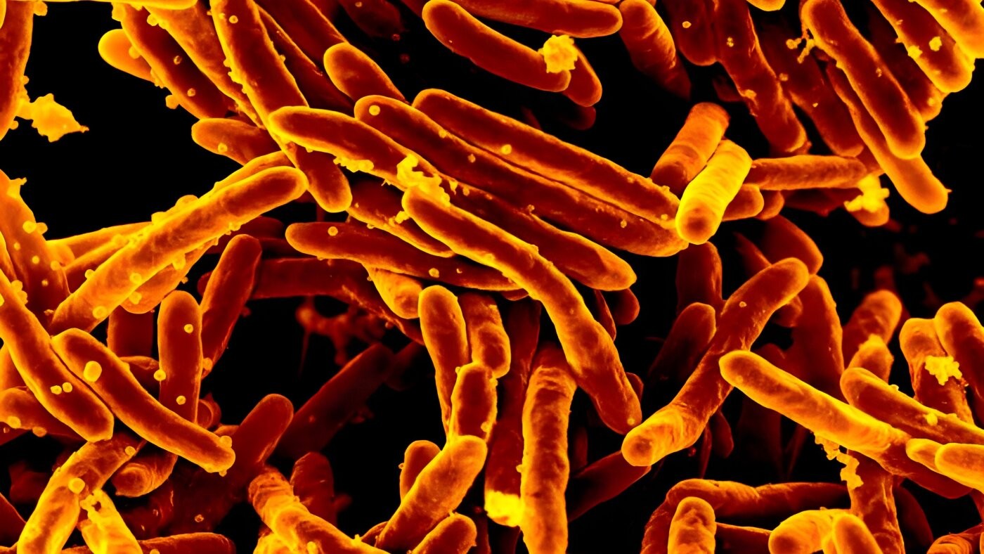 اختبار جديد للسل يتيح التشخيص السريع بدقة عبر البلغم أو مسحة اللسان