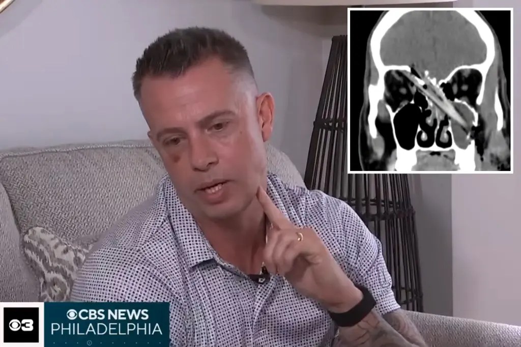 أب من نيوجيرسي ينجو بعد اختراق غصن فكه ووصوله إلى الدماغ إثر سقوطه من سلم
