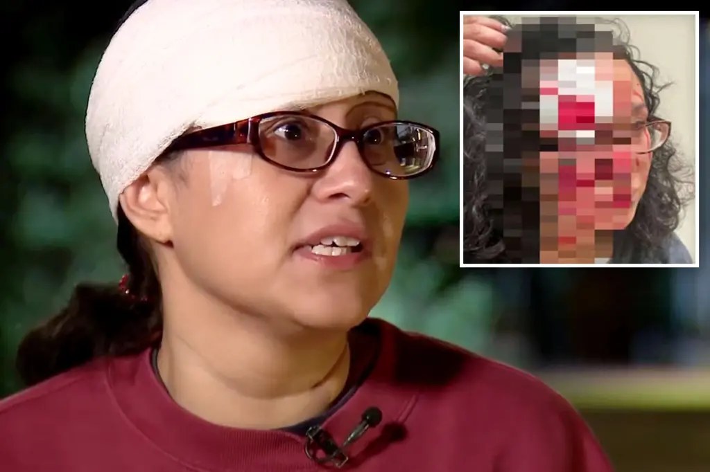 اتهام امرأة بالاعتداء بعد عضّ جزء من جبين سيدة في سياتل
